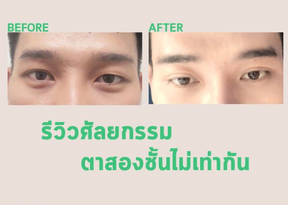รีวิวศัลยกรรมแก้ตาสองชั้นไม่เท่ากัน