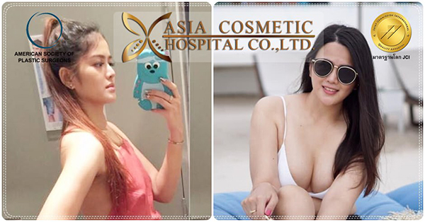 รีวิวทำหน้าอก