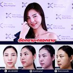 ผ่าตัดกราม