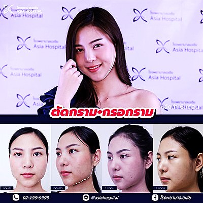 ผ่าตัดกราม ลดเหลี่ยมบนใบหน้า