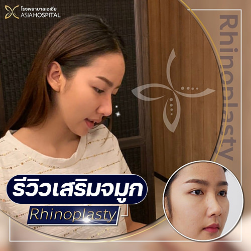 เสริมจมูกแบบโอเพ่น รีวิวแก้ไขจมูกสั้น ดูเป็นธรรมชาติ