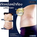 ตัดหนังหน้าท้อง