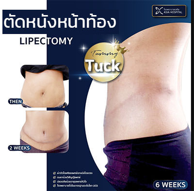 ผ่าตัดหนังหน้าท้อง แล้วสามารถมีลูก ตั้งครรภ์ ได้ไหม